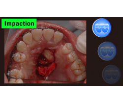 Impaction Course