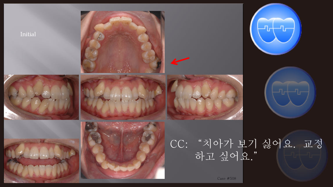 교정 Case 508. U5L4 발치, Class I, Severe Crowding, Scissor-bite, Root Resorption, Anterior Crossbite, Sem #12.3