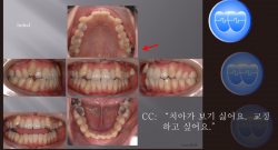 교정 Case 508. U5L4 발치, Class I, Severe Crowding, Scissor-bite, Root Resorption, Anterior Crossbite, Sem #12.3