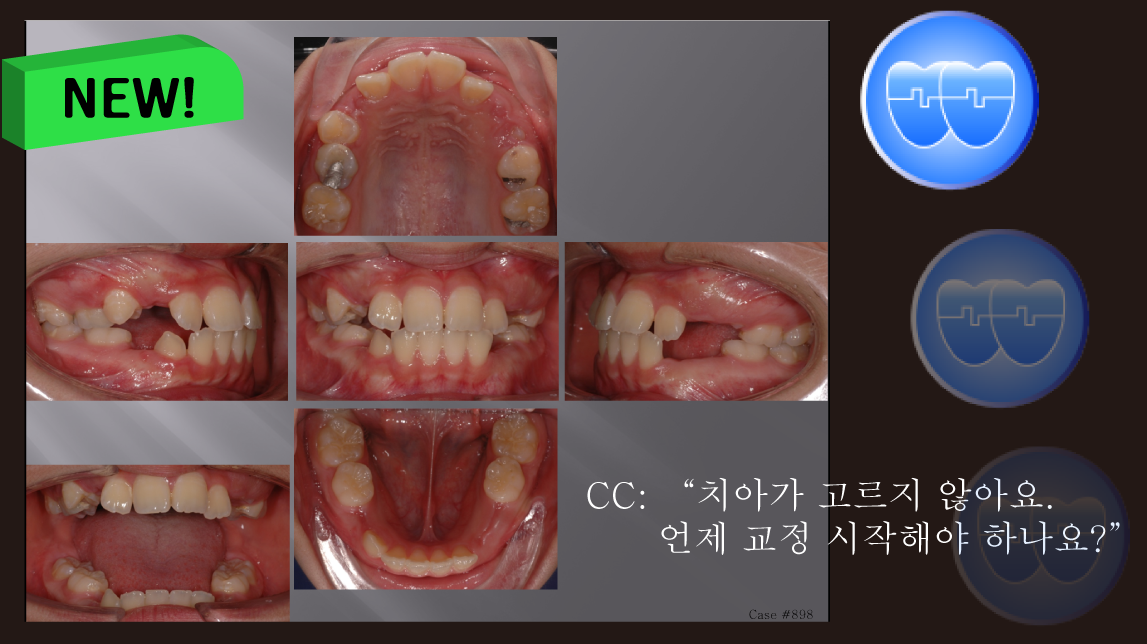 교정 Case 898.  비발치, Expansion, #37 Impaction, Sem #14