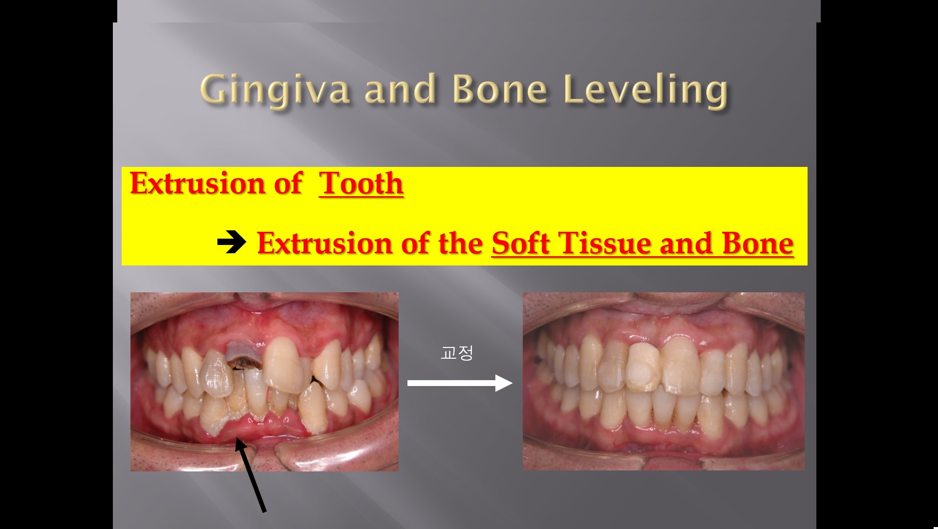 (강의 47) Seminar #20 Perio-Ortho 강의 (Part 2)