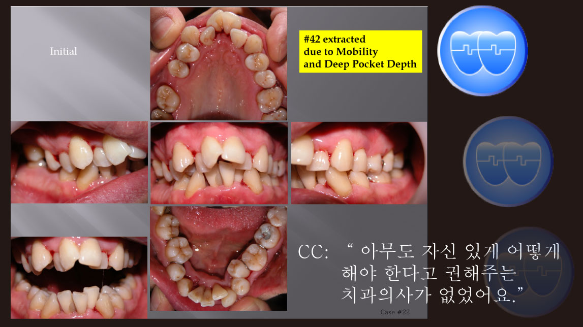 교정 Case 22.  비대칭 발치(#14, #24, #35, #42, #45), Perio-Ortho, Sem #20