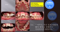 교정 Case 22.  비대칭 발치(#14, #24, #35, #42, #45), Perio-Ortho, Sem #20