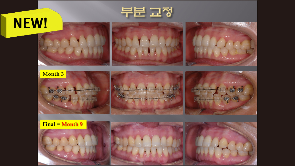 (강의 52) Sem #20.5 부분교정 강의 (Part 2)
