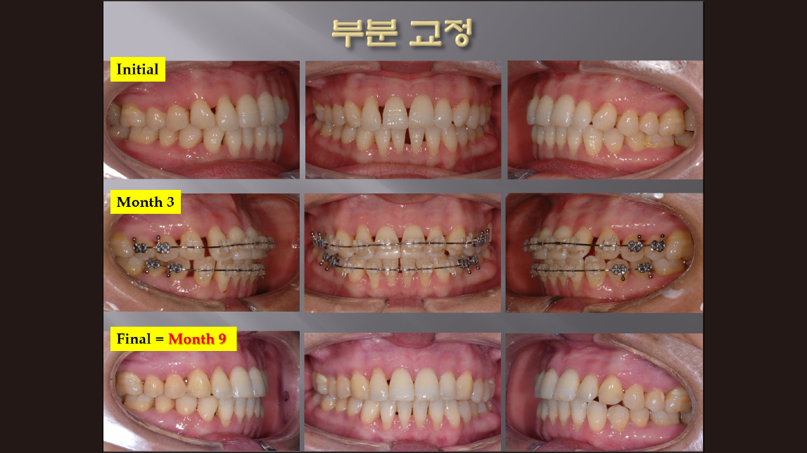 (강의 52) Sem #20.5 부분교정 강의 (Part 2)