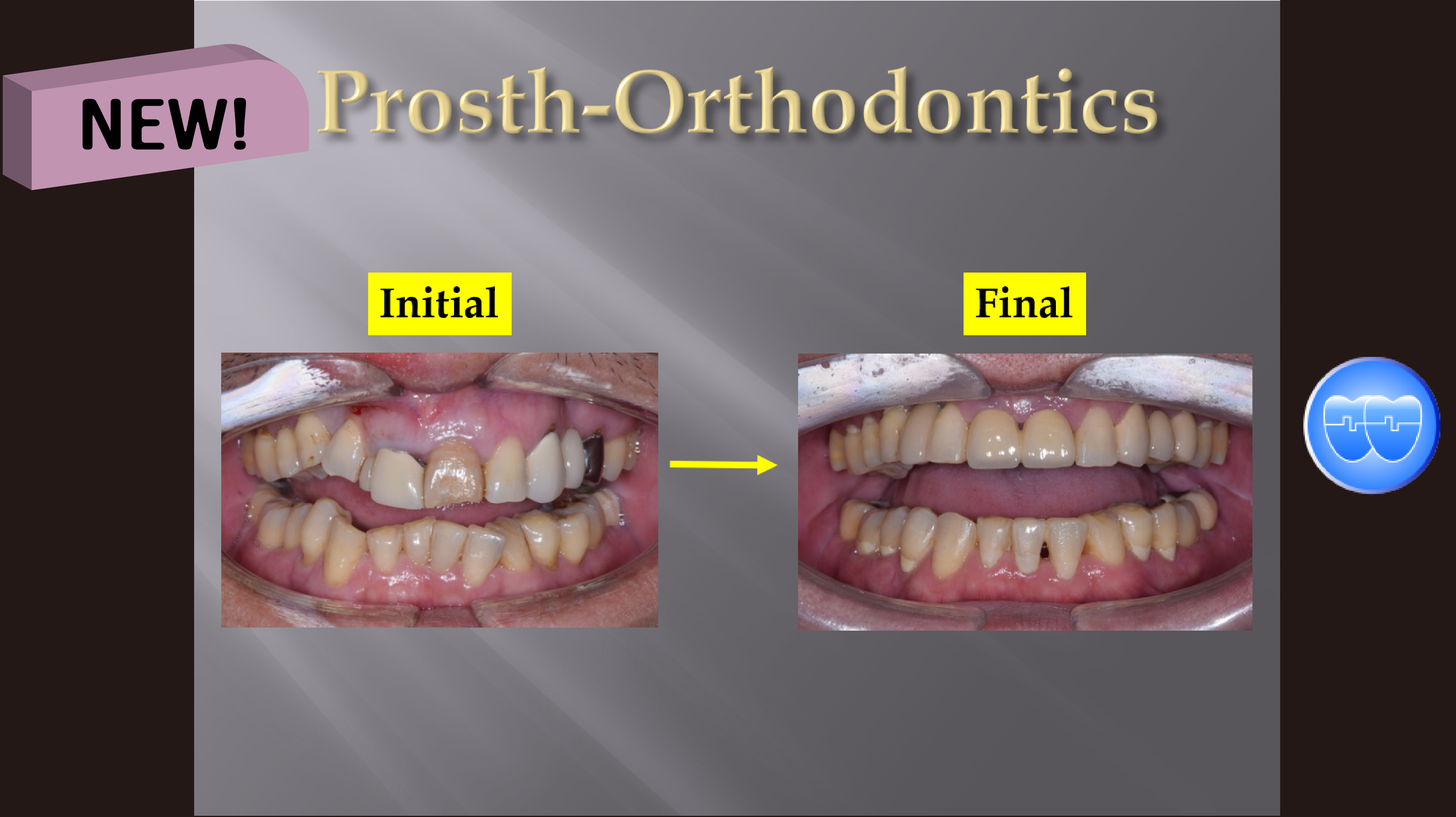 (강의 53) Sem #20.5 Prosth-Orthodontics 강의