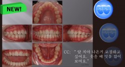 교정 Case 899.  U5 발치, Class II, Moderate Protrusion with Overjet, Sem #12.6
