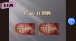 (강의 36) Sem #15  Class II. (Part I. Diagnosis and Characteristics)