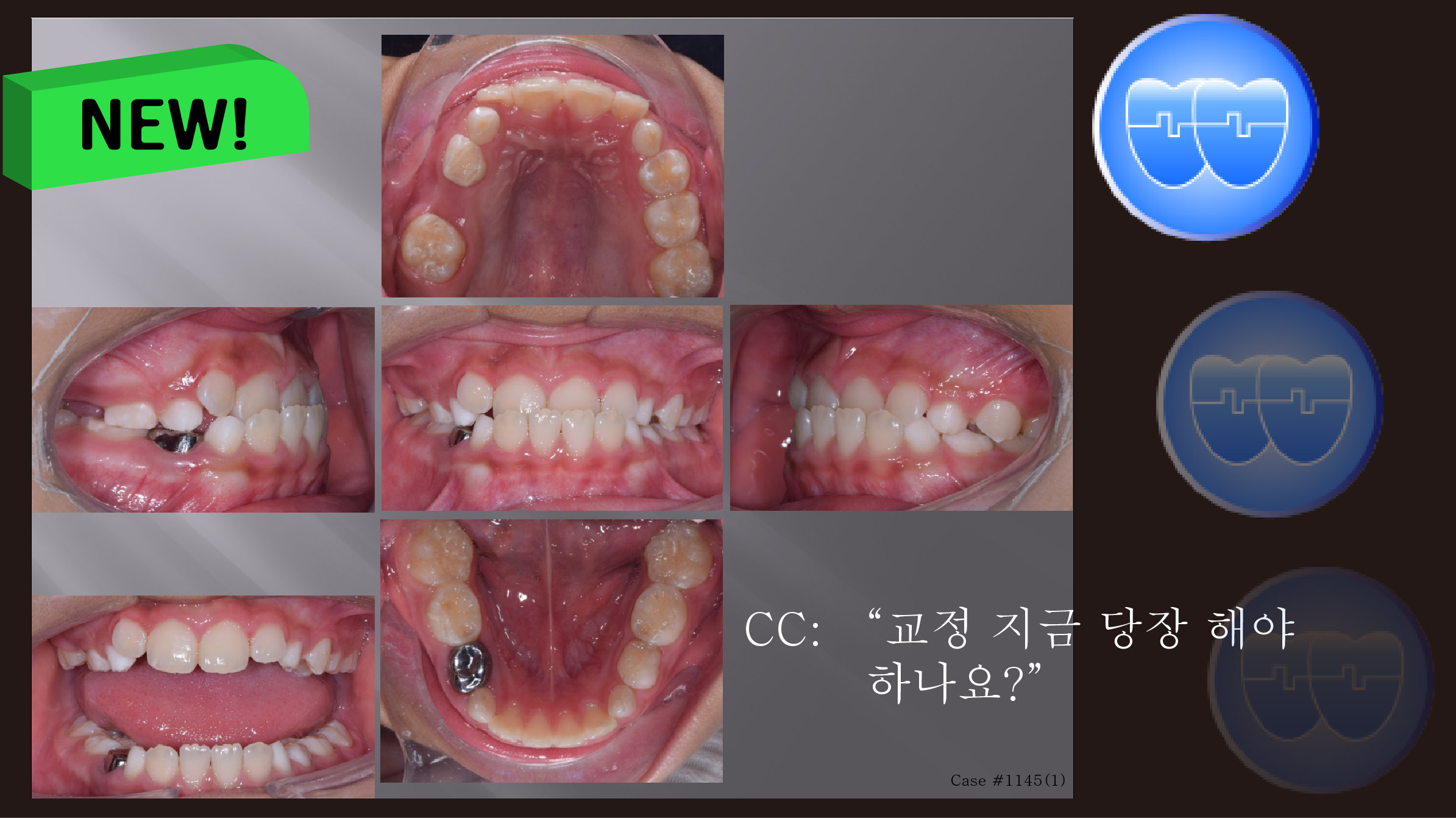 교정 Case 1145(1).  1차 교정, Anterior Crossbite, Advancing Z Arch, RHG, SS Open Coil Spring, Sem #9