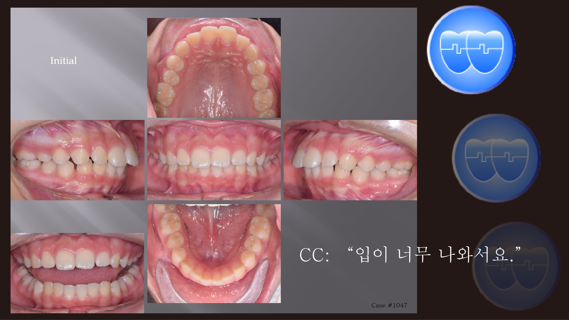 교정 Case 1047.  U5L5 발치, Skeletal Class II, Protrusion, Sem #12.4