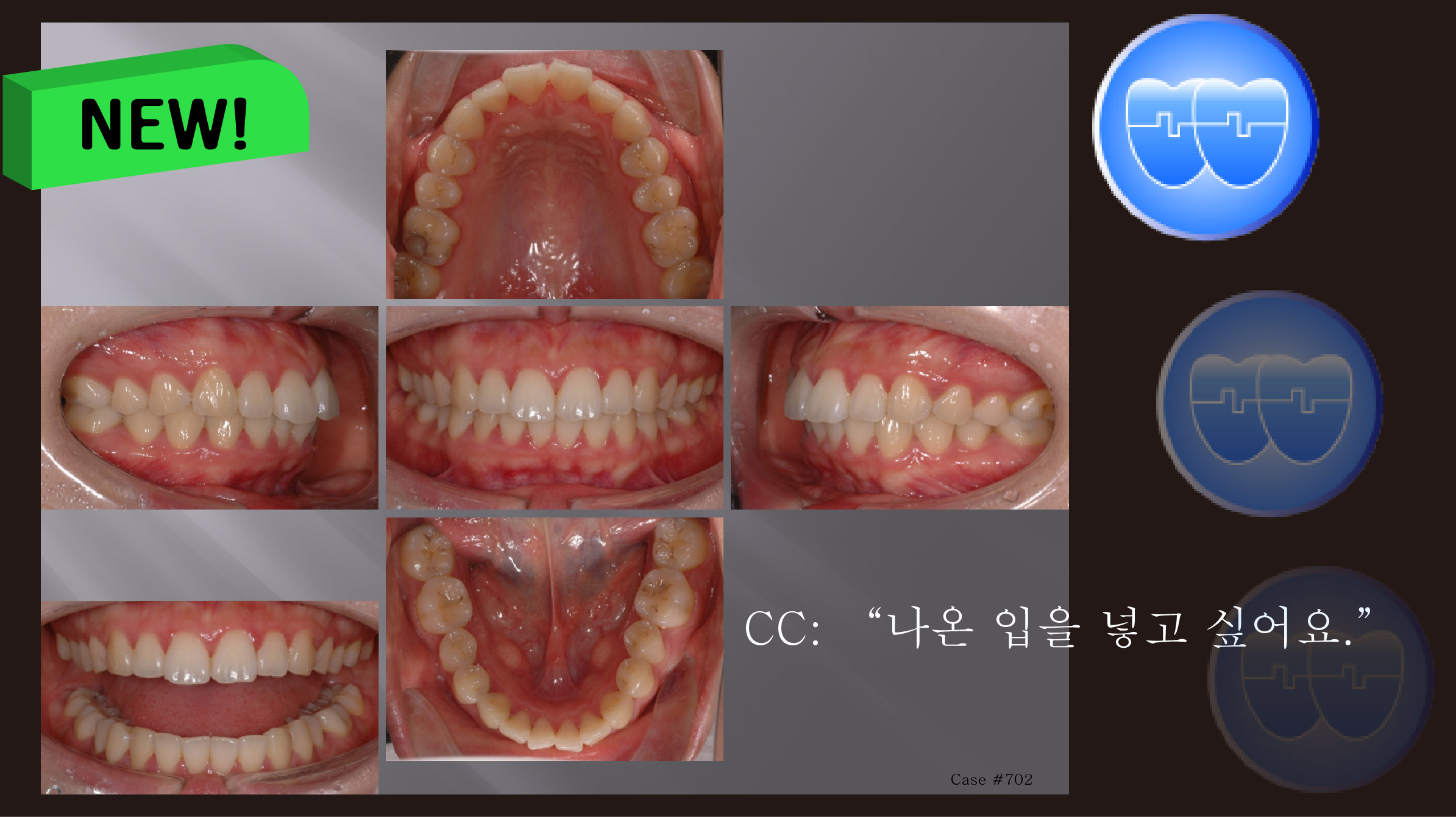 교정 Case 702. U5L5 발치, Skeletal Class II, Protrusion, Sem #12.4