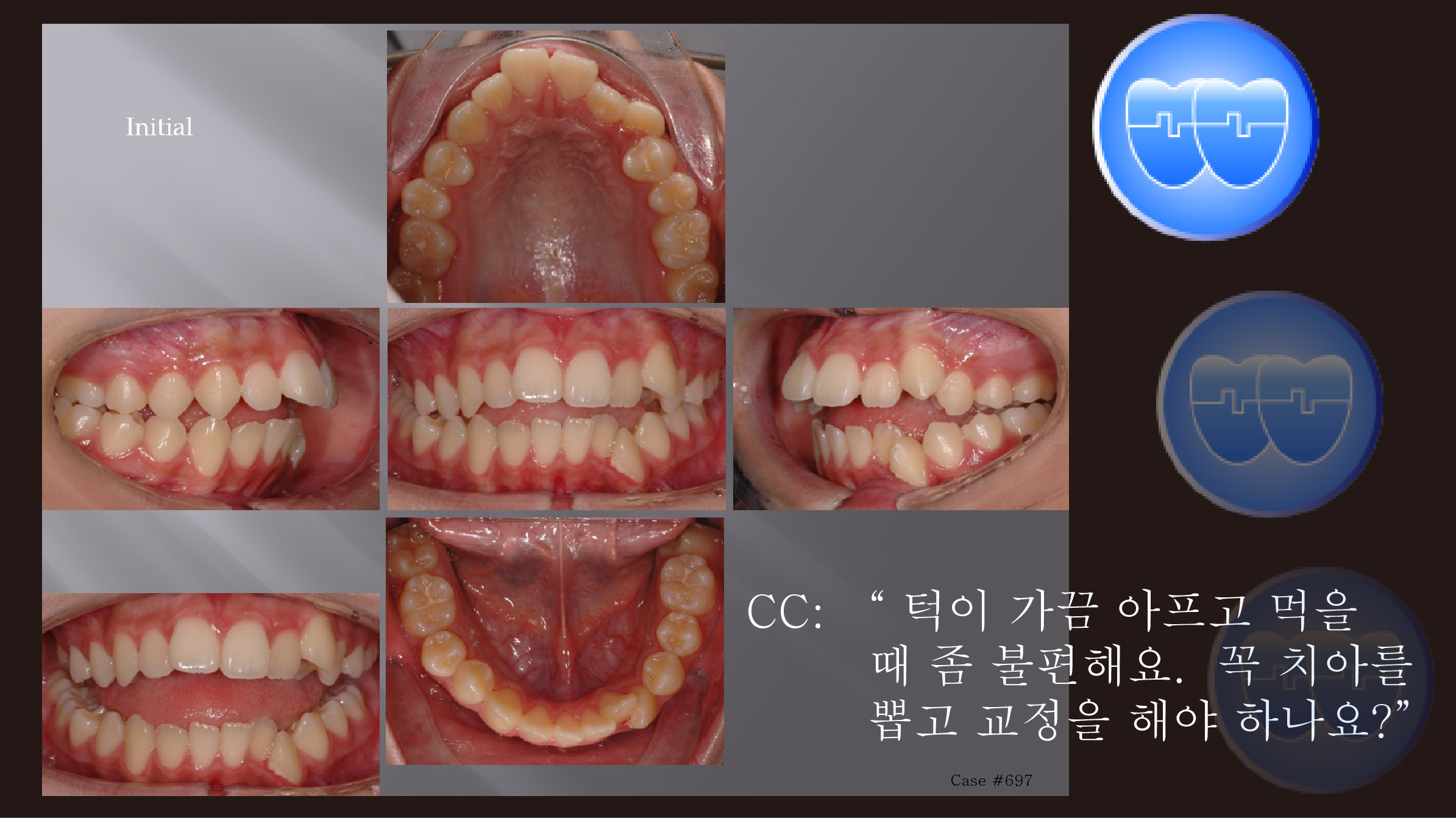 교정 Case 697.  U5L5 발치, Skeletal Class II, TMJ, Molar Intrusion to Close Open bite, Sem #19