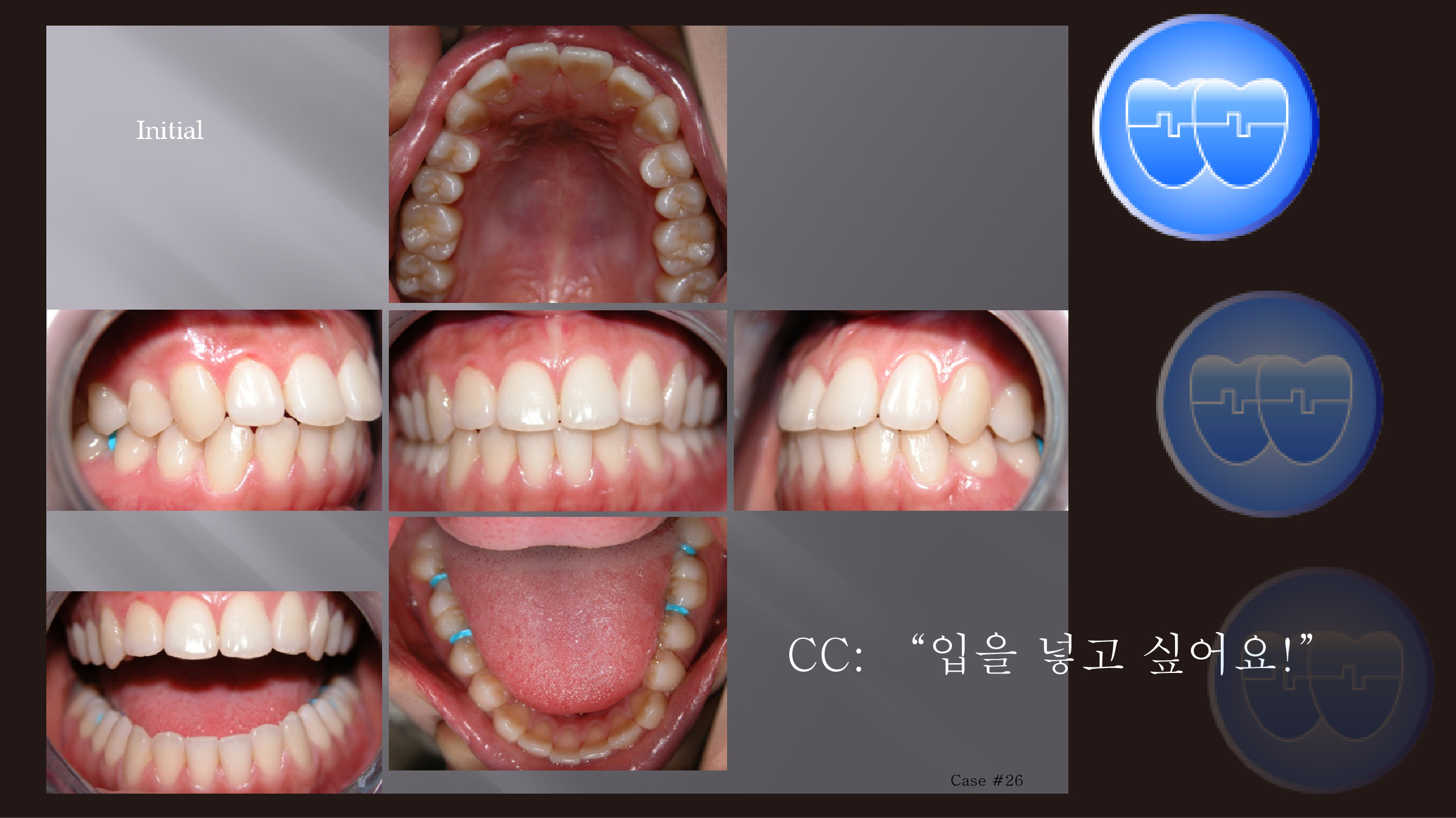 교정 Case 26.  U4L4 발치, Protrusion, Mechanics 진행 실수, Sem #12.1