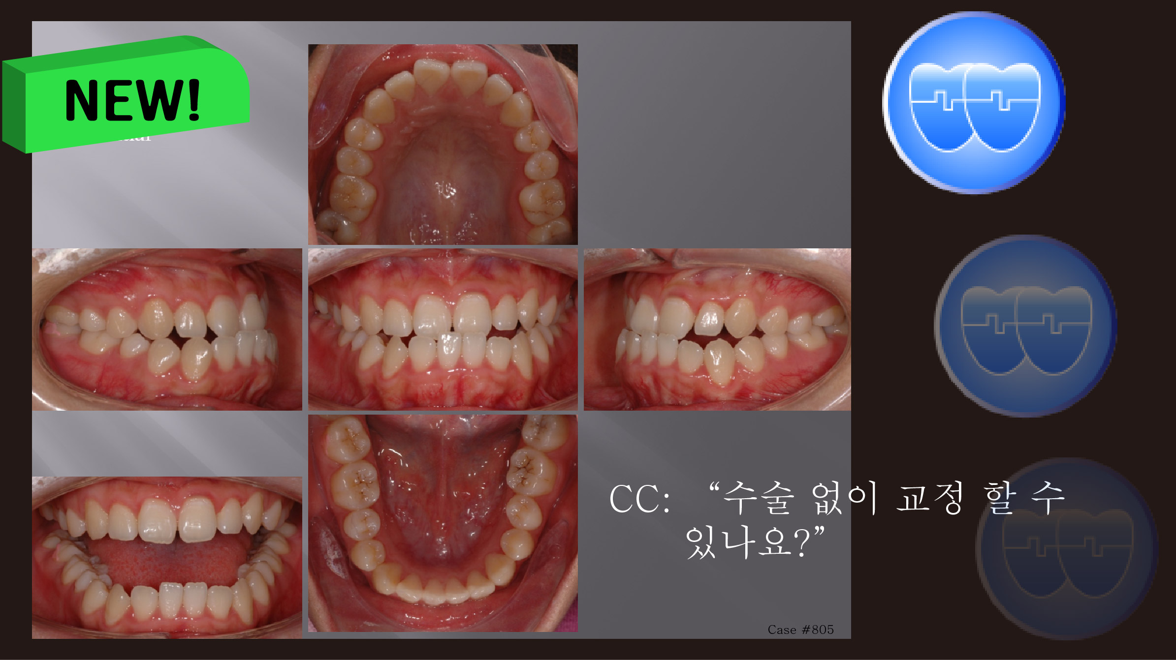 교정 Case 805.  Lower 4 발치, Dental Openbite, Lower Lingual Corticotomy, Sem #13.7