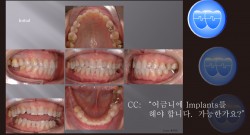 교정 Case 500.  Intrusion of #16 and #17 with Miniscrew, 실패한 Case, Sem #7.7