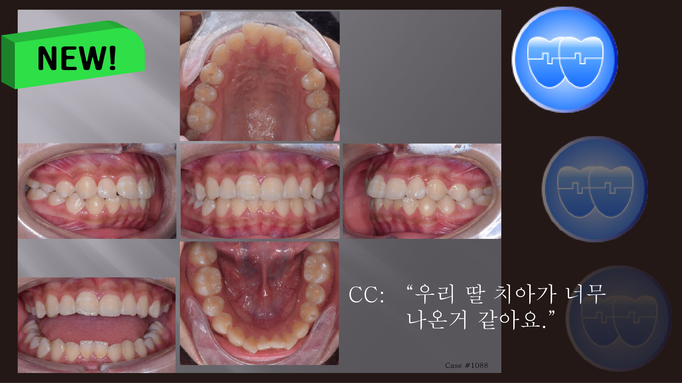 교정 Case 1088.  U5L5 발치, Protrusion, Gummy Smile, Sem #12.4