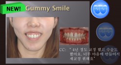 교정 Case 669. U4L4 발치, 재교정, Skeletal Class II, Severe Gummy Smile, Sem 7.5