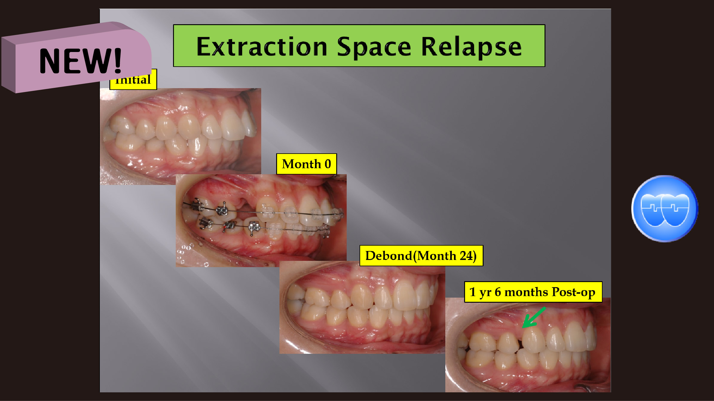 (강의 49) Sem #18 Retention and Relapse (Part II-1)-Relapse의 원인과 해결책