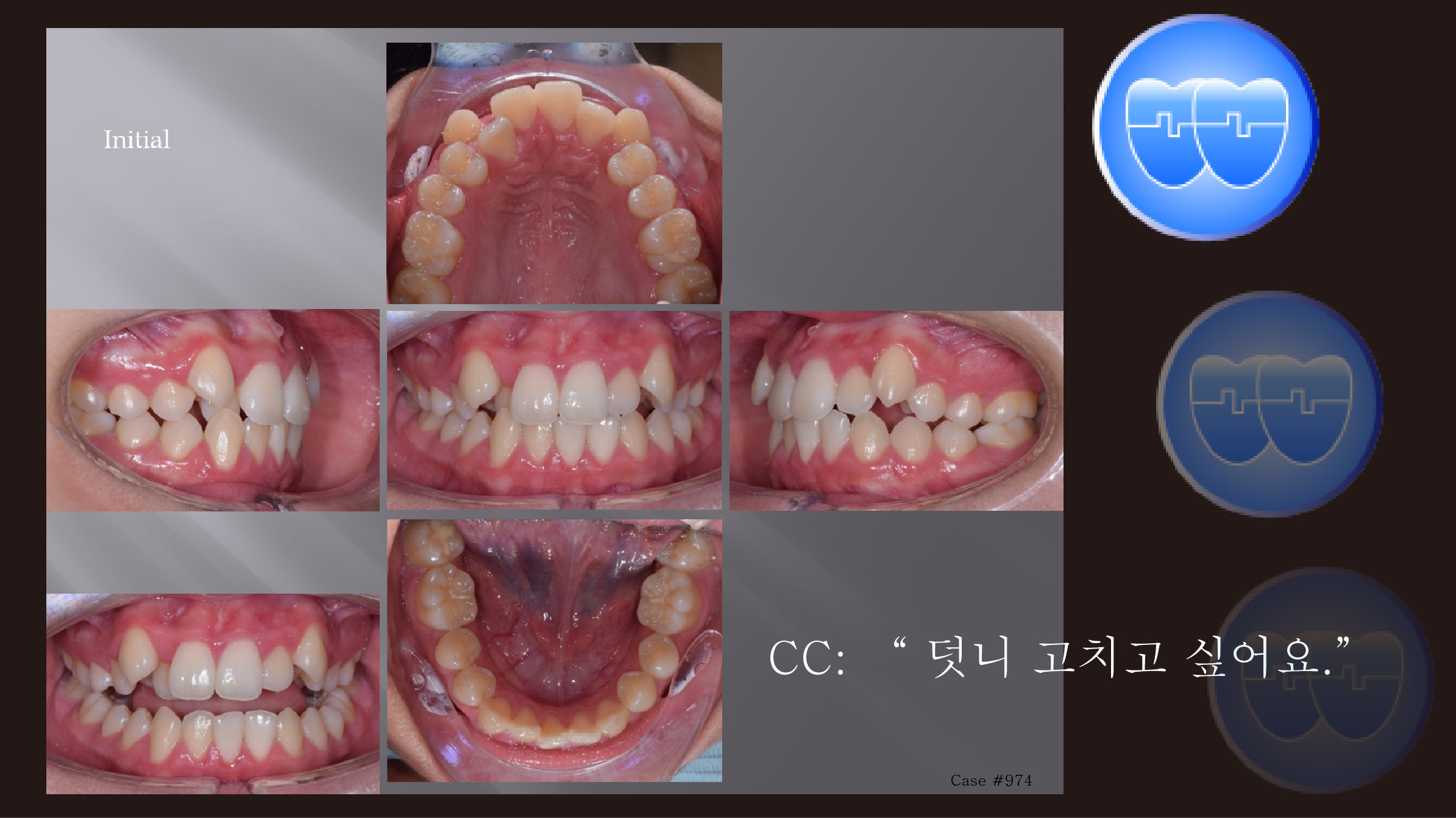 교정 Case 974.  U5L1 발치, L1 Congenital Missing, Class III, Sem #13