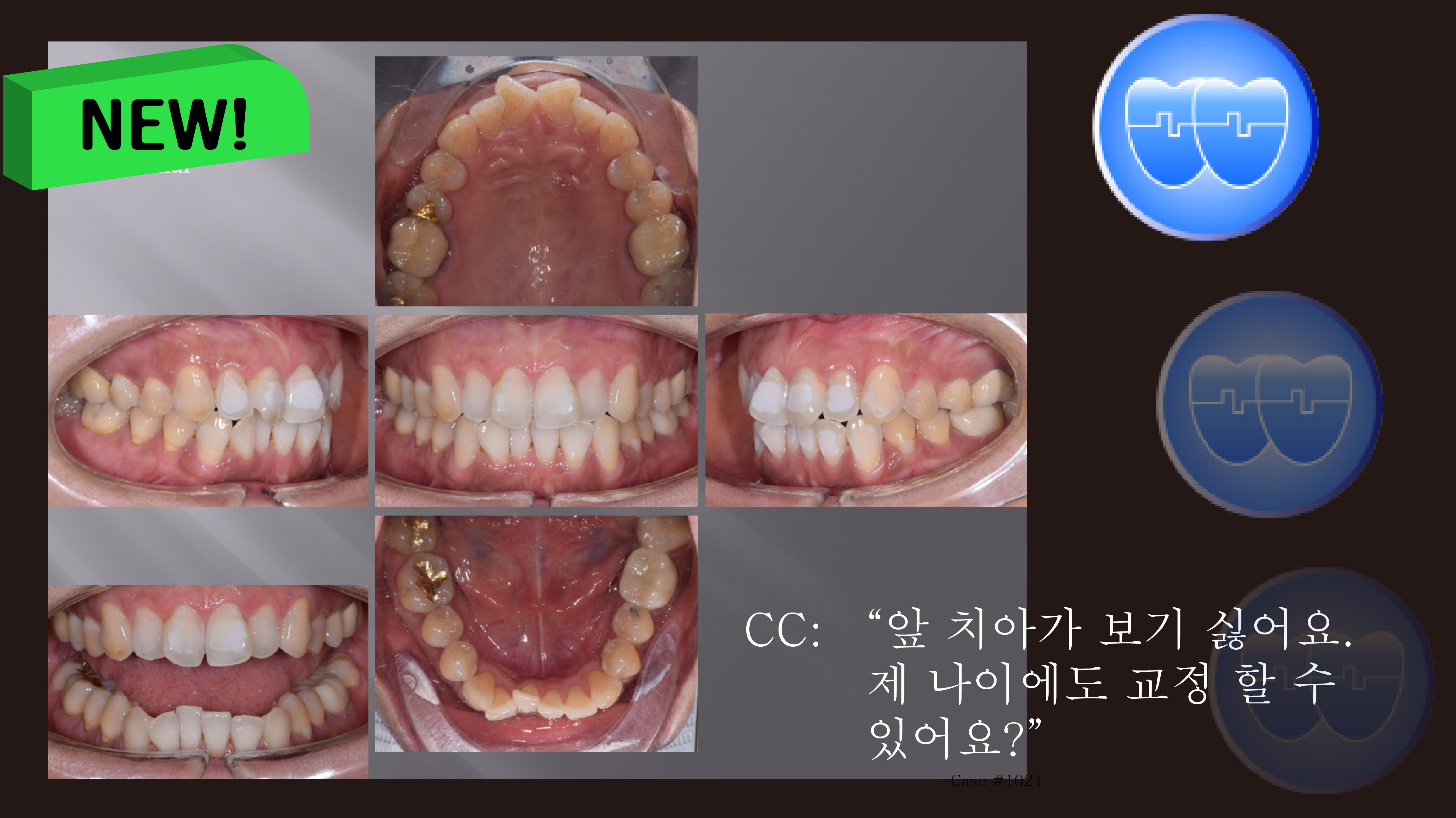 교정 Case 1319. 부분교정, Rotated Anterior Teeth, Sem #20.5