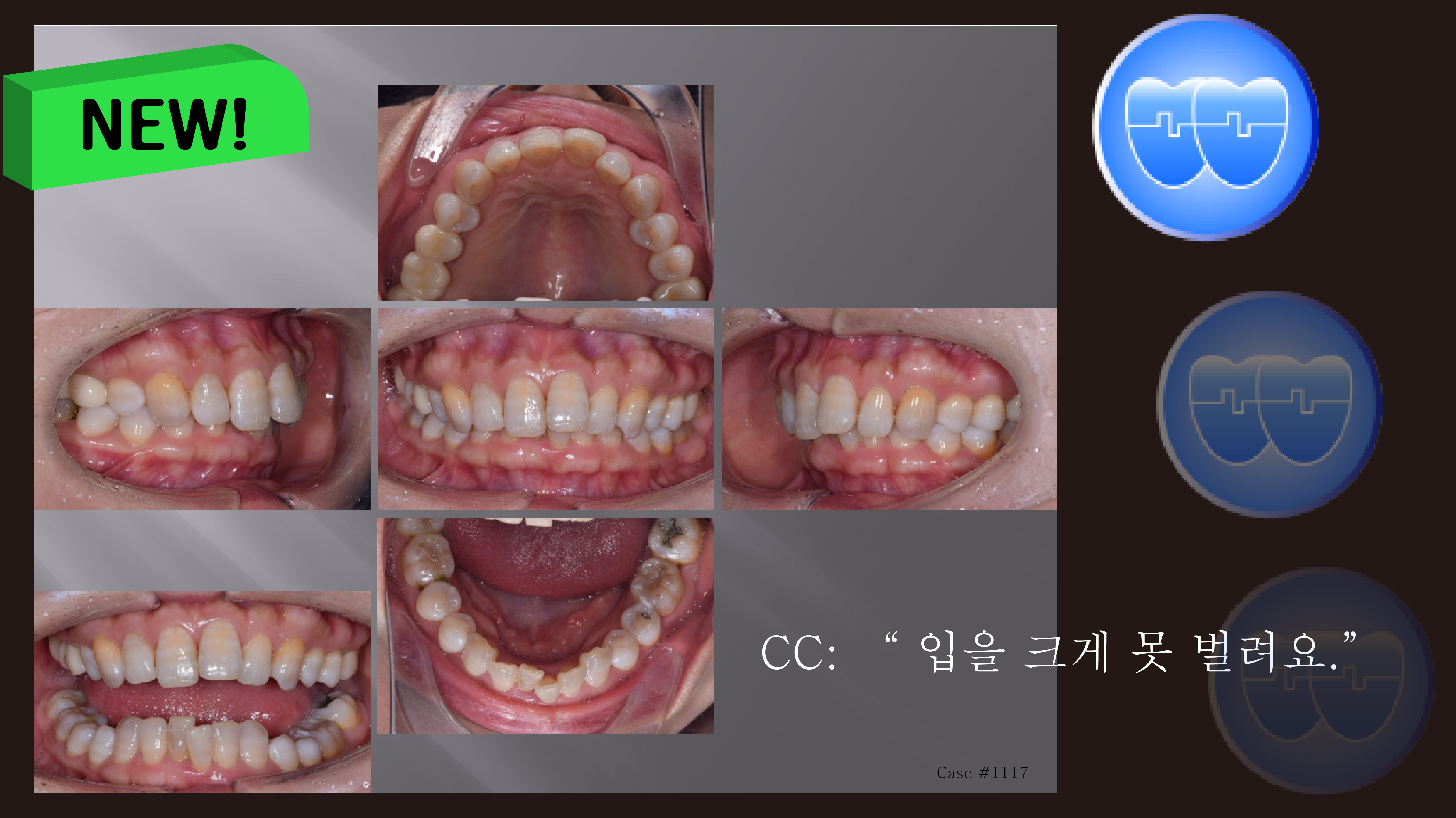 교정 Case 1117. 비발치, TMJ, Dental Deepbite, Sem #19