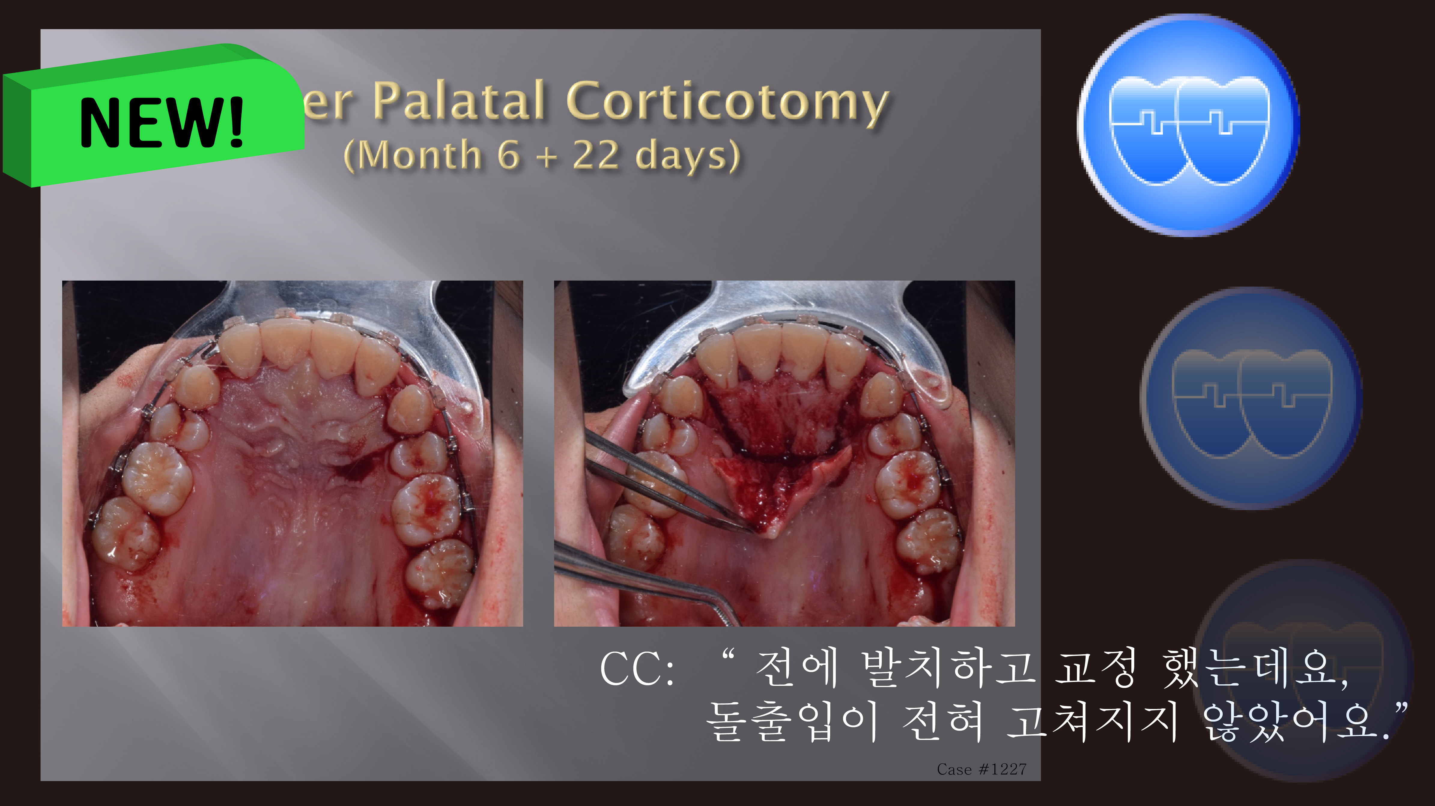 교정 Case 1227. Transferred Pt., Protrusion, U & L Corticotomy, Gummy Smile, Sem #13.7(New,로고)