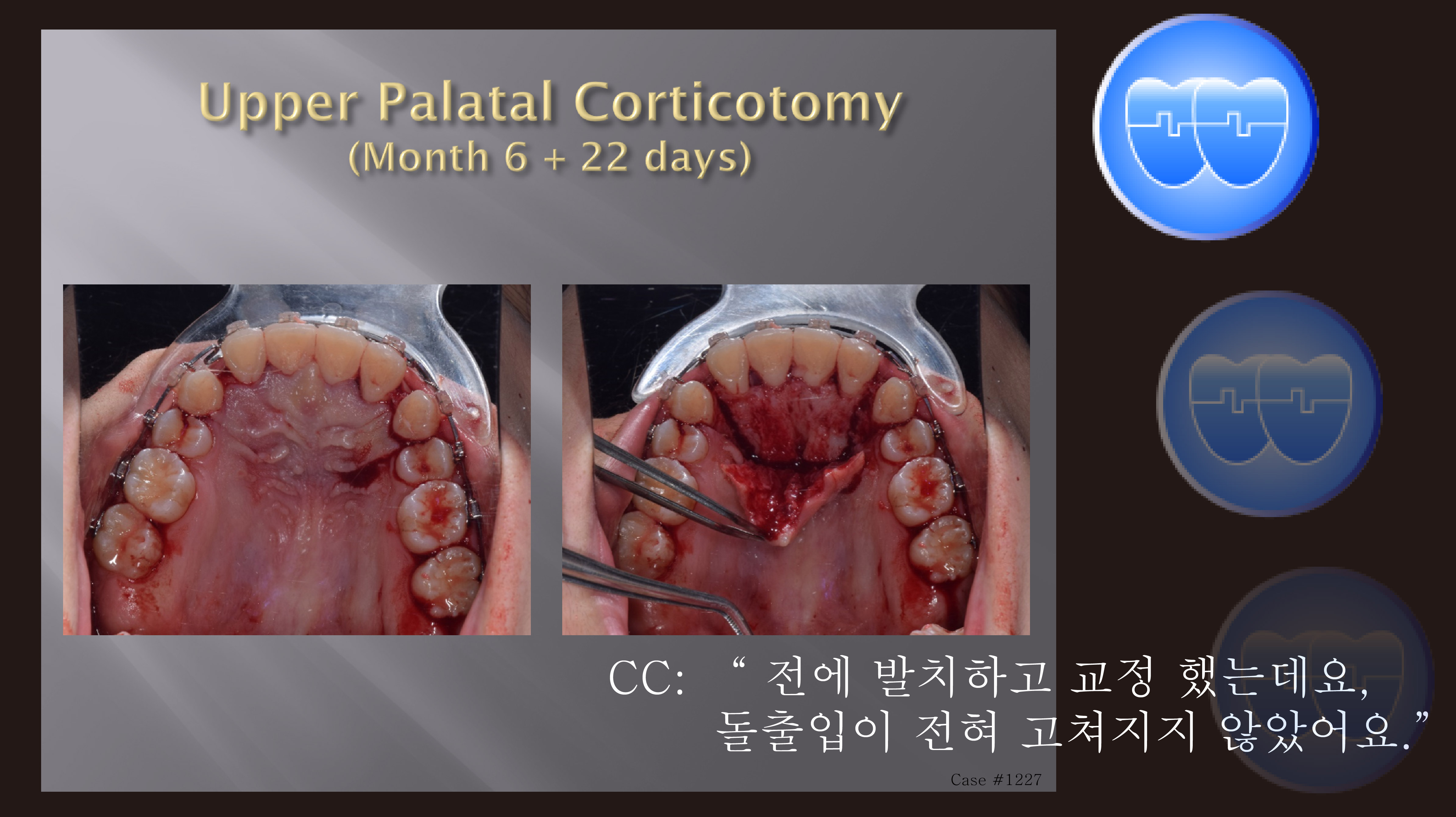 교정 Case 1227. Transferred Pt., Protrusion, U & L Corticotomy, Gummy Smile, Sem #13.7(New,로고)