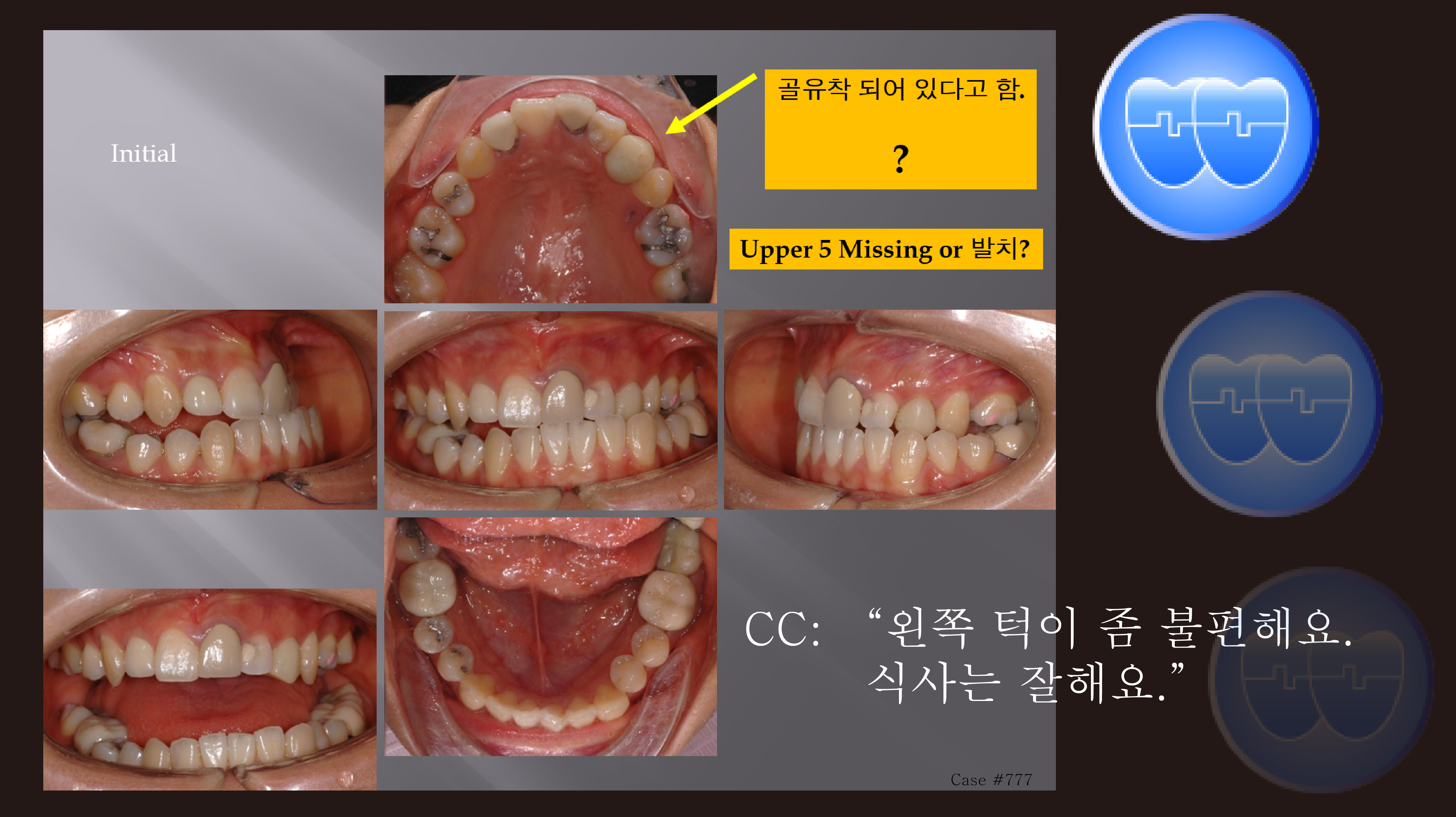 교정 Case 777. U5L4 발치, Ectopic Eruption, Functional Shift, Lower Lingual Corticotomy for Lower Torque Control, Sem #19