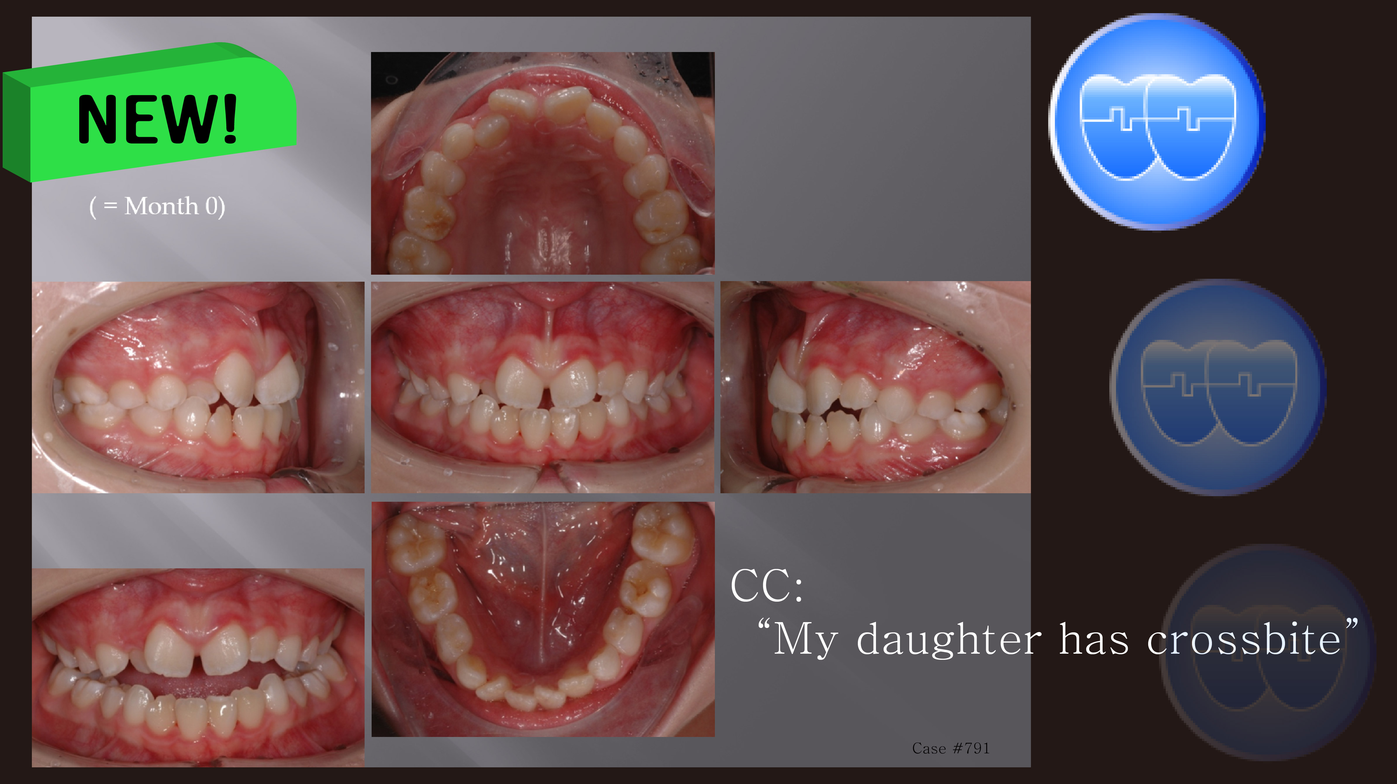 교정 Case 791. 1차 교정, Anterior Crossbite, Sem #9