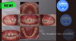 교정 Case 791. 1차 교정, Anterior Crossbite, Sem #9