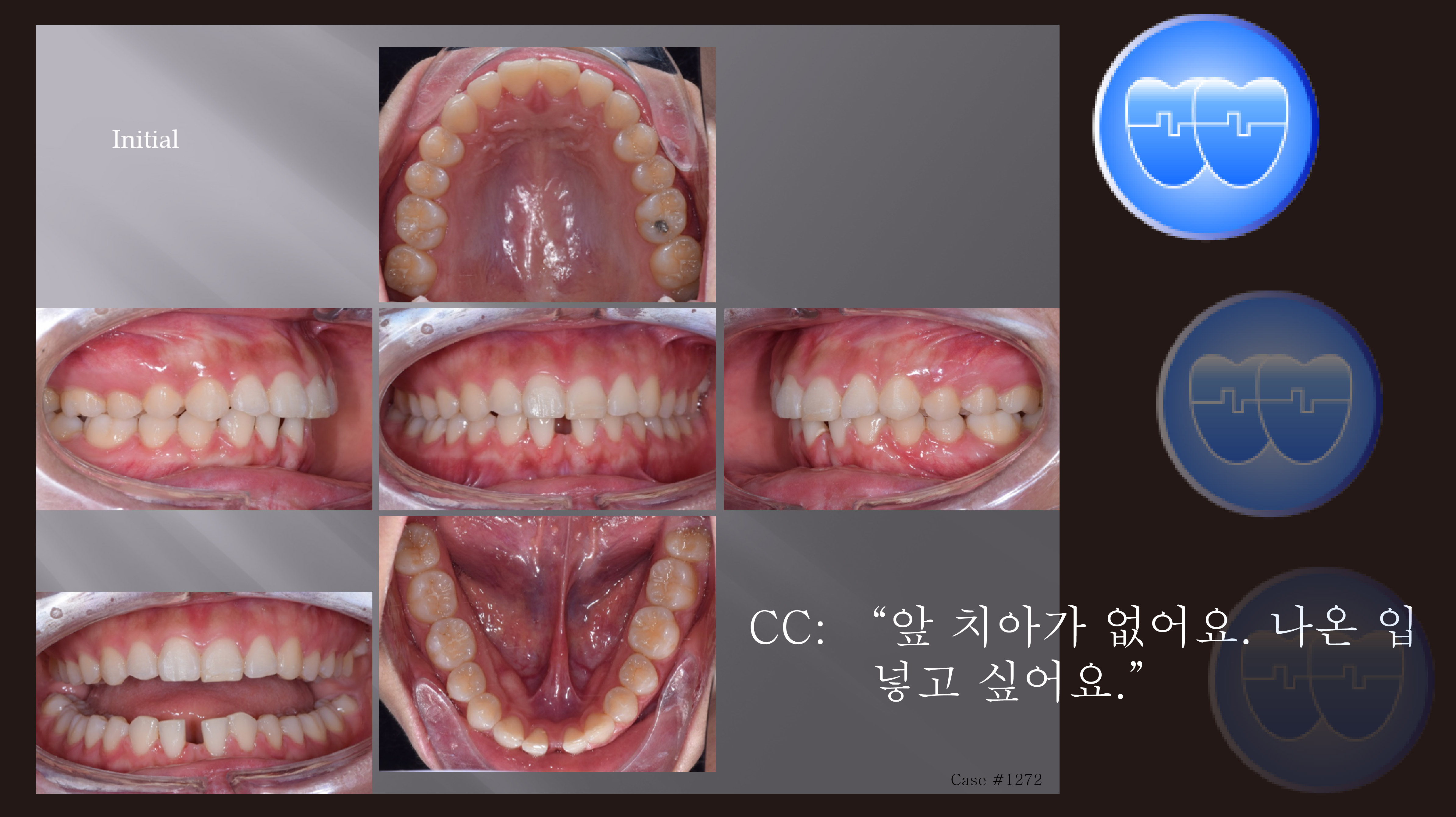 교정 Case 1272. U5L2 발치, Congenital Missing Two L. Incisors, Root Resorption, Sem #13