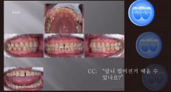 교정 Case 1421. Difficulty of Anterior Space Closing with Power Chain, Sem # 20.5