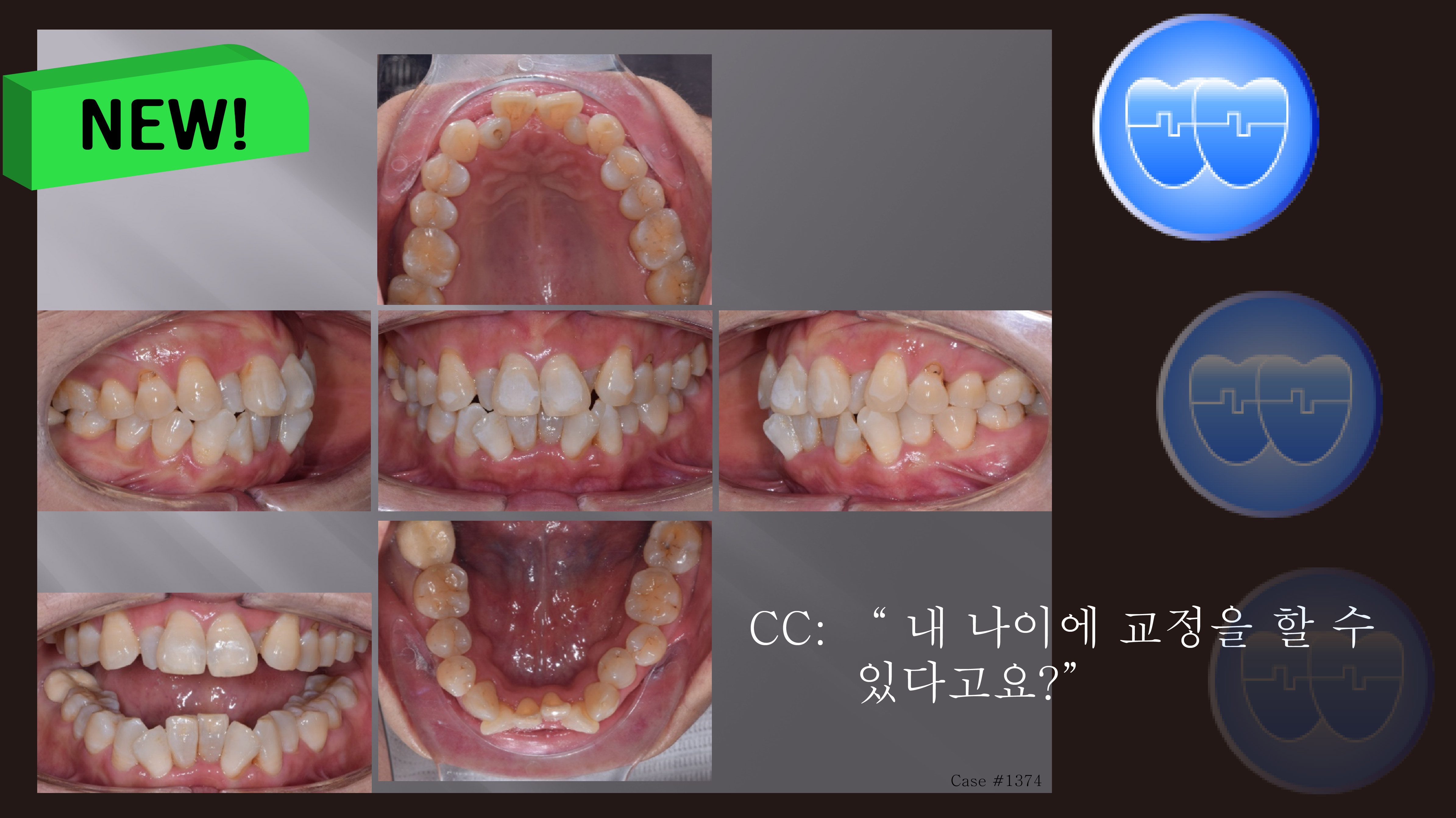 교정 Case 1374. L1 발치, 부분교정, Anterior Crossbite, Lower Crowding, Sem #20.5