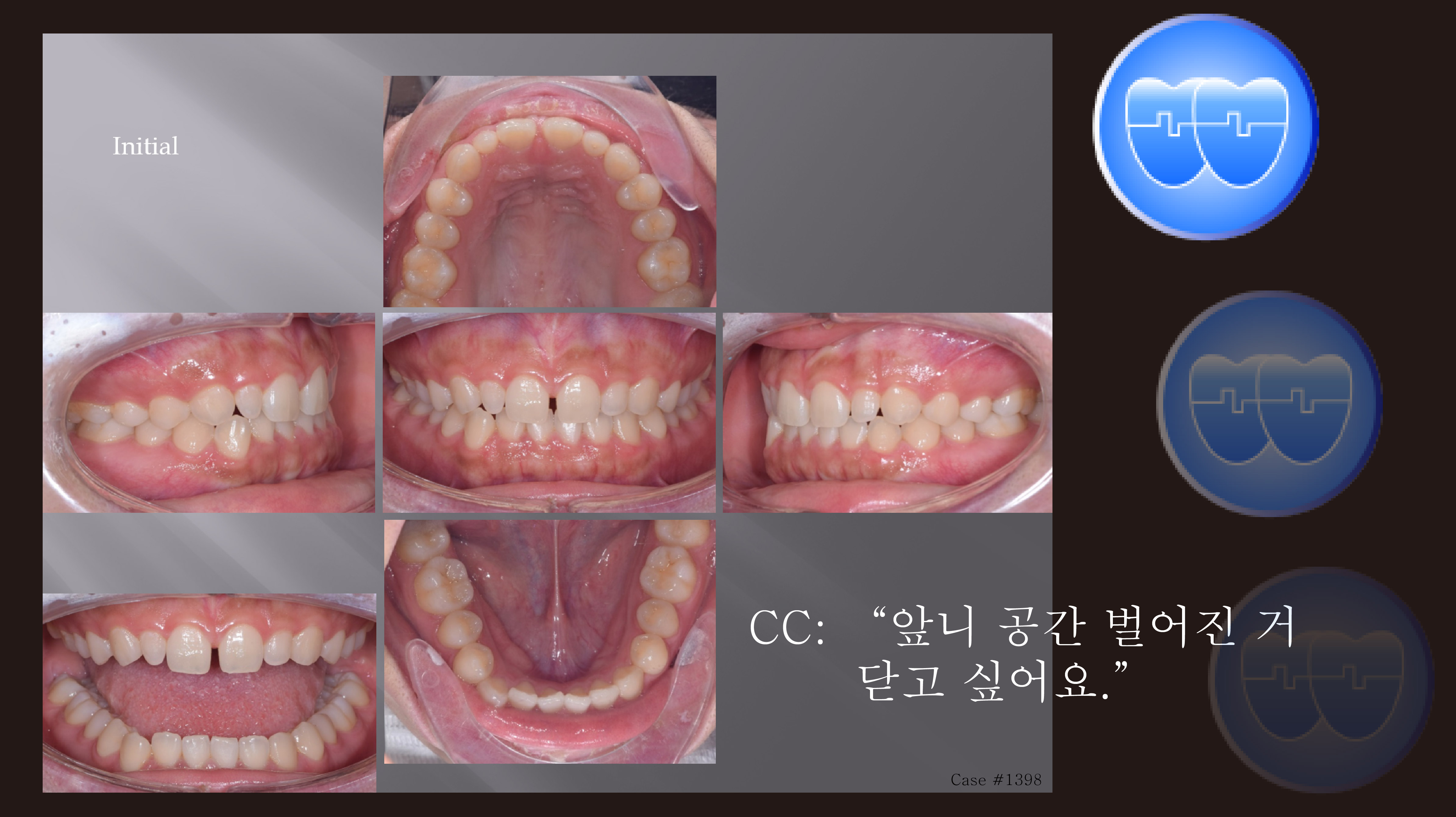 교정 Case 1398. 비발치, 부분교정, Upper Diastema, Sem #20.5