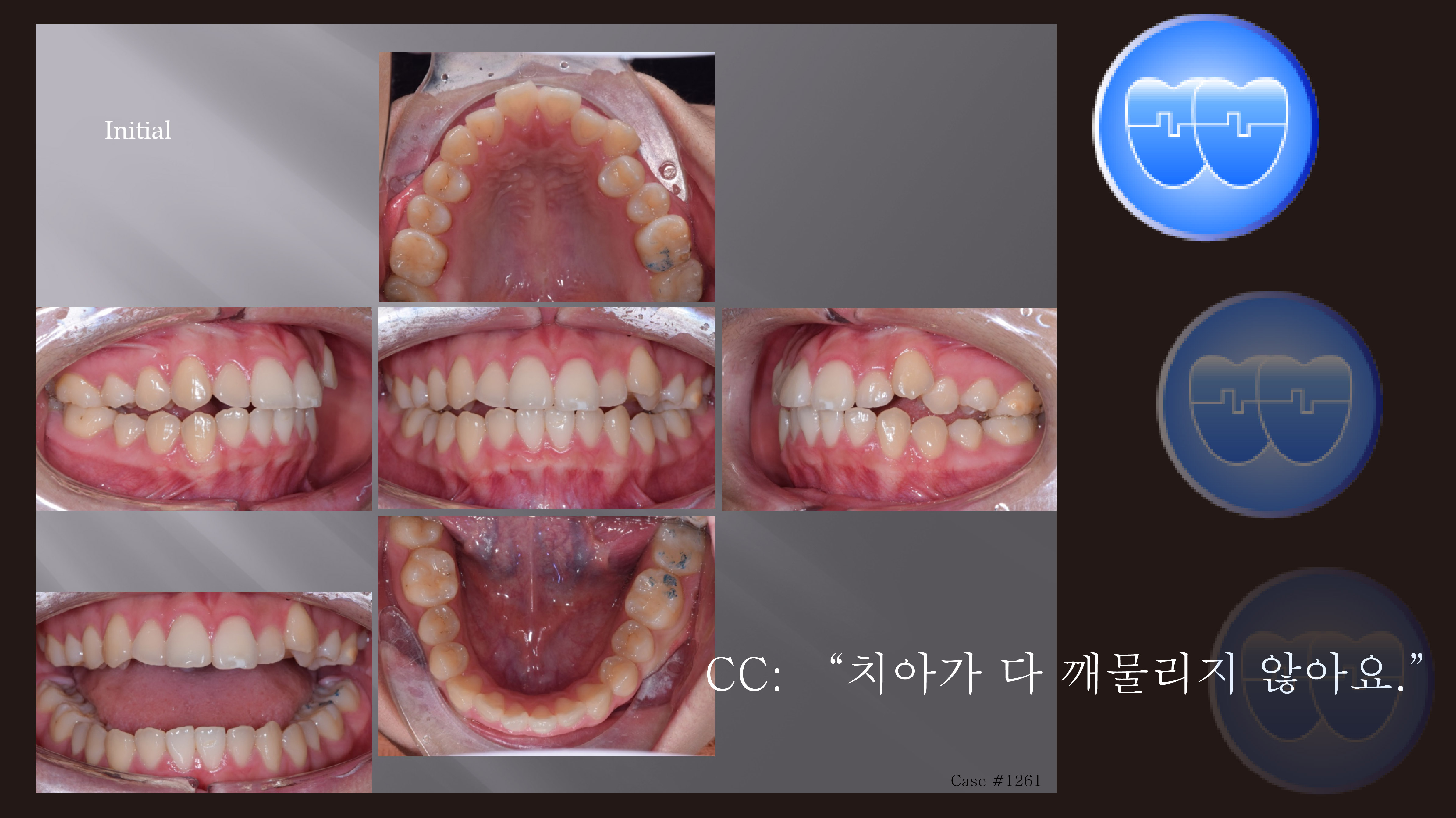 교정 Case 1261. U5 발치, 실수한 Case, Dental Openbite, Power Chain의 부작용, Sem #12.6