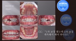 교정 Case 1130. 비발치, Class III, Functional Shift의 변화, 1차교정에서 (교정 Case 858) 연결, Sem #9