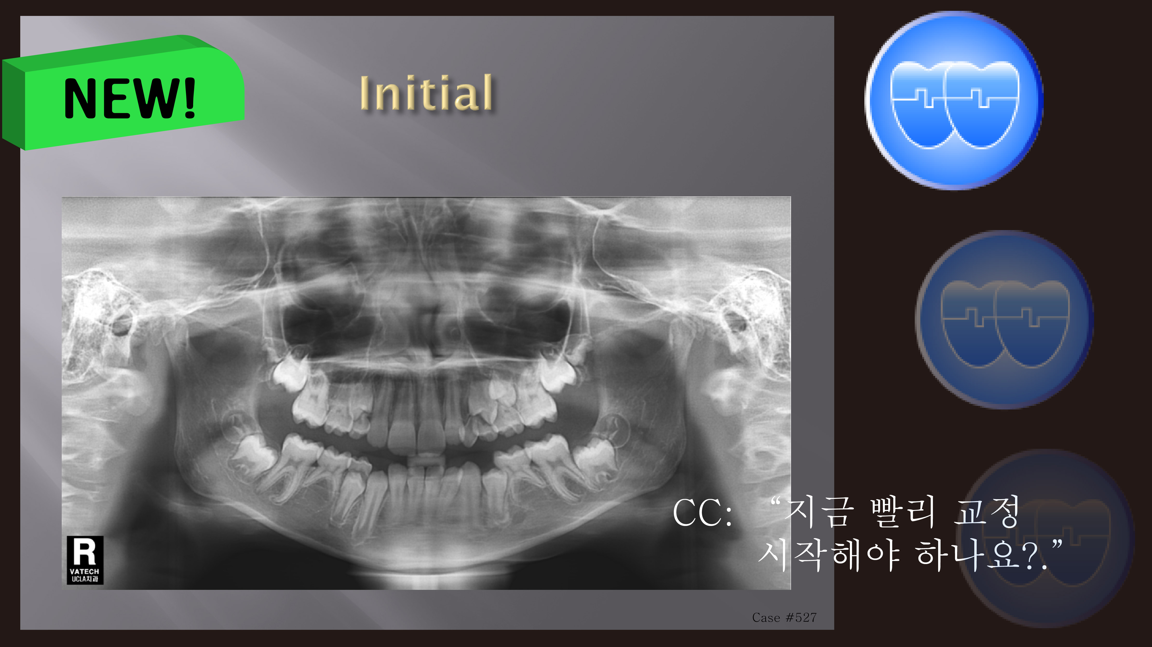 교정 Case 527.  비대칭 발치, Multiple Missing Teeth, Sem # 13.2