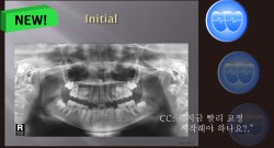 교정 Case 527.  비대칭 발치, Multiple Missing Teeth, Sem # 13.2