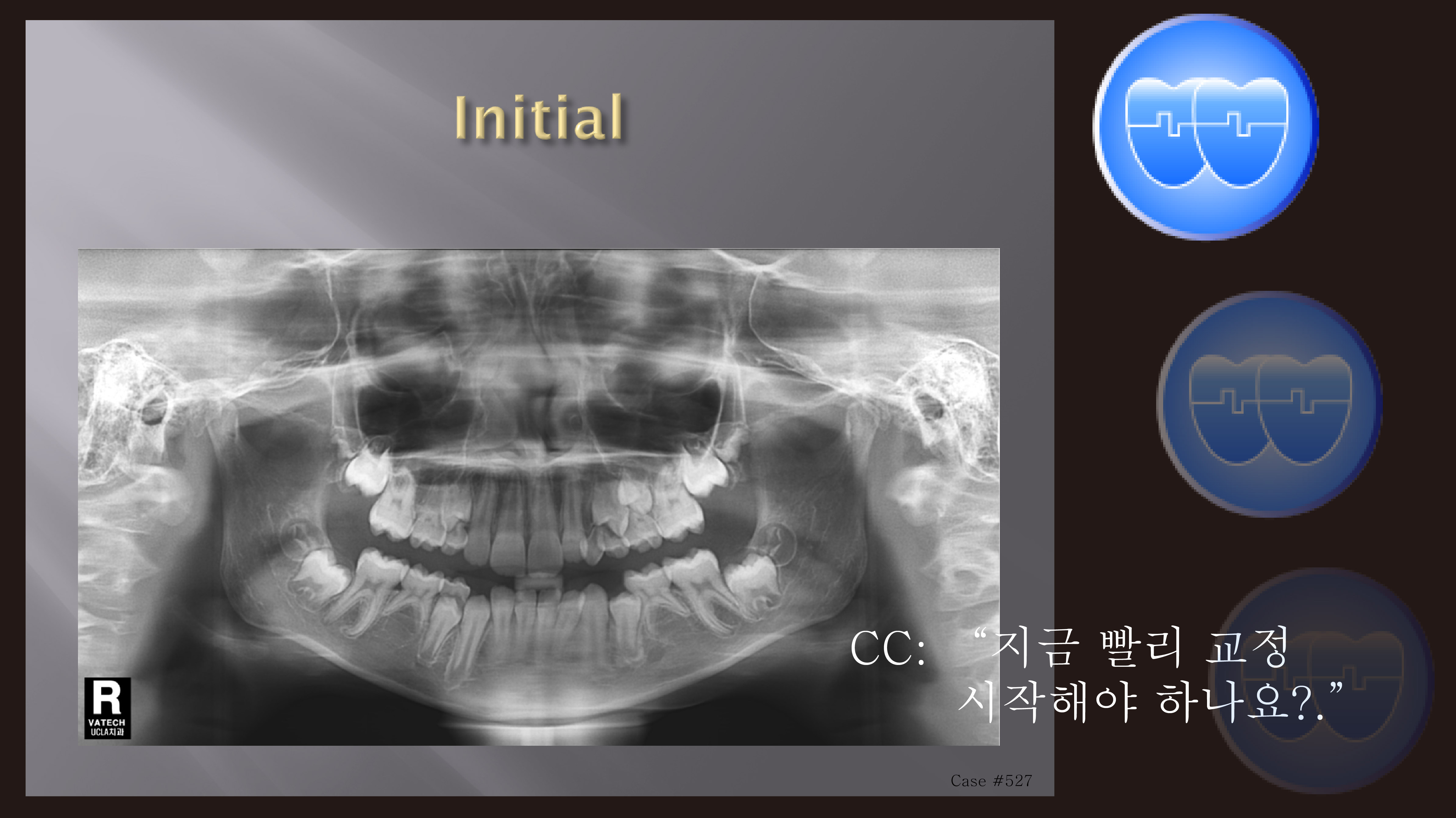 교정 Case 527. 비대칭 발치, Multiple Missing Teeth, Sem # 13.2