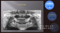 교정 Case 527. 비대칭 발치, Multiple Missing Teeth, Sem # 13.2