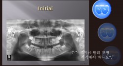 교정 Case 527. 비대칭 발치, Multiple Missing Teeth, Sem # 13.2