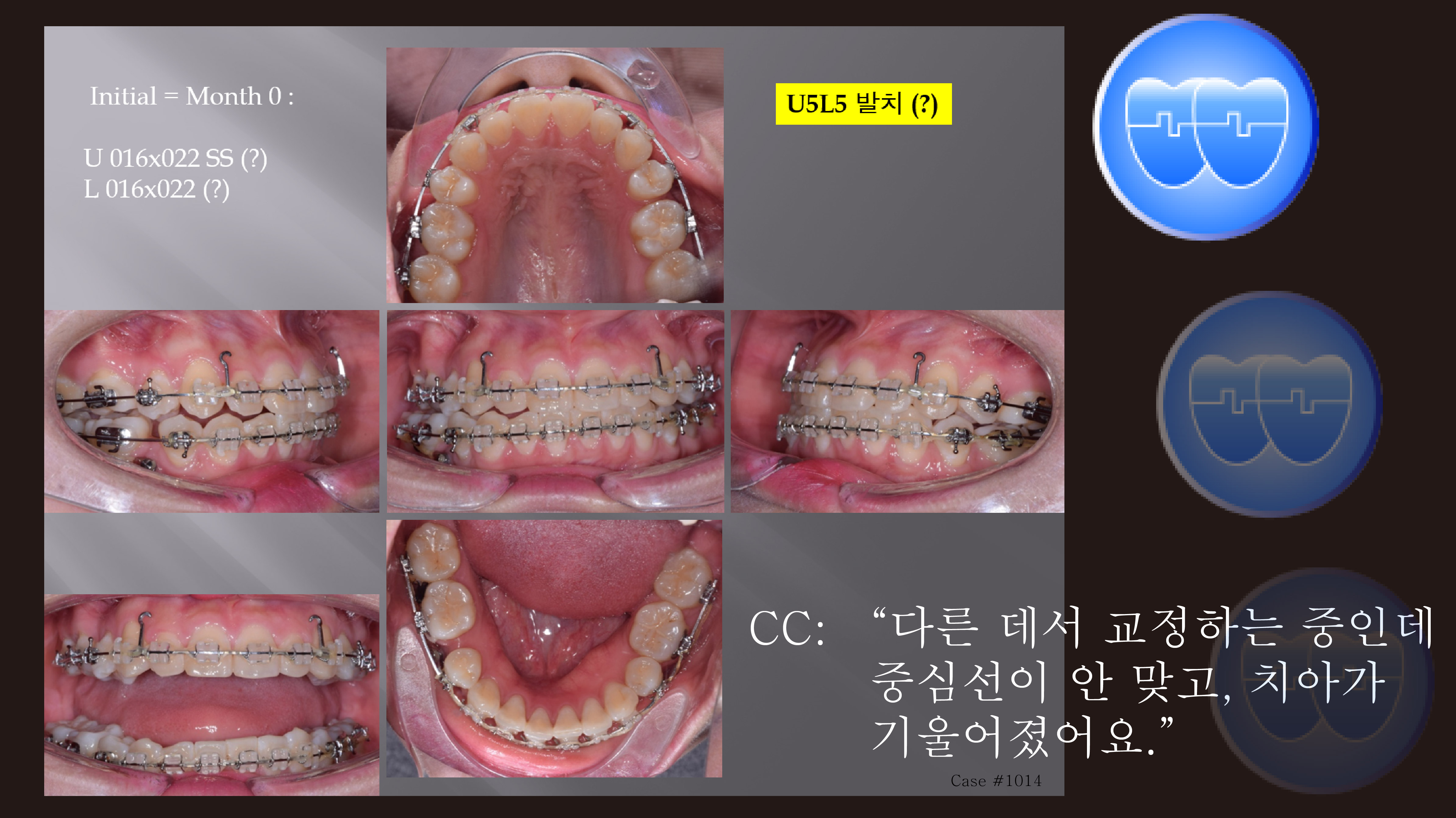 교정 Case 1014. Transferred Pt., Midline Correction, Posterior Crossbite, Sem #7.8