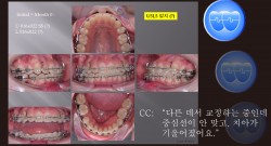 교정 Case 1014. Transferred Pt., Midline Correction, Posterior Crossbite, Sem #7.8