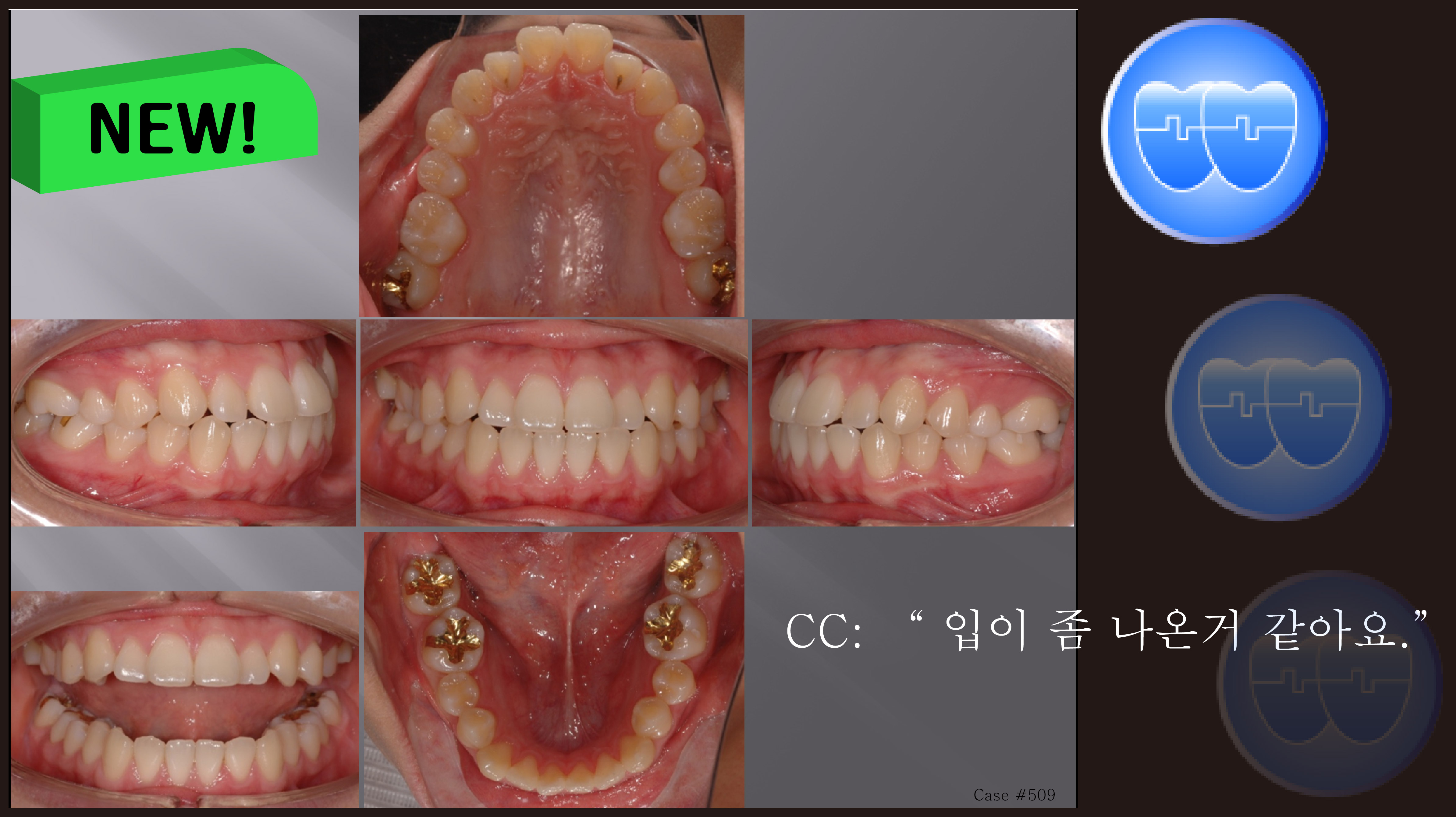 교정 Case 509. U5L4 발치, Protrusion, Sem #12.3