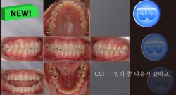 교정 Case 509. U5L4 발치, Protrusion, Sem #12.3