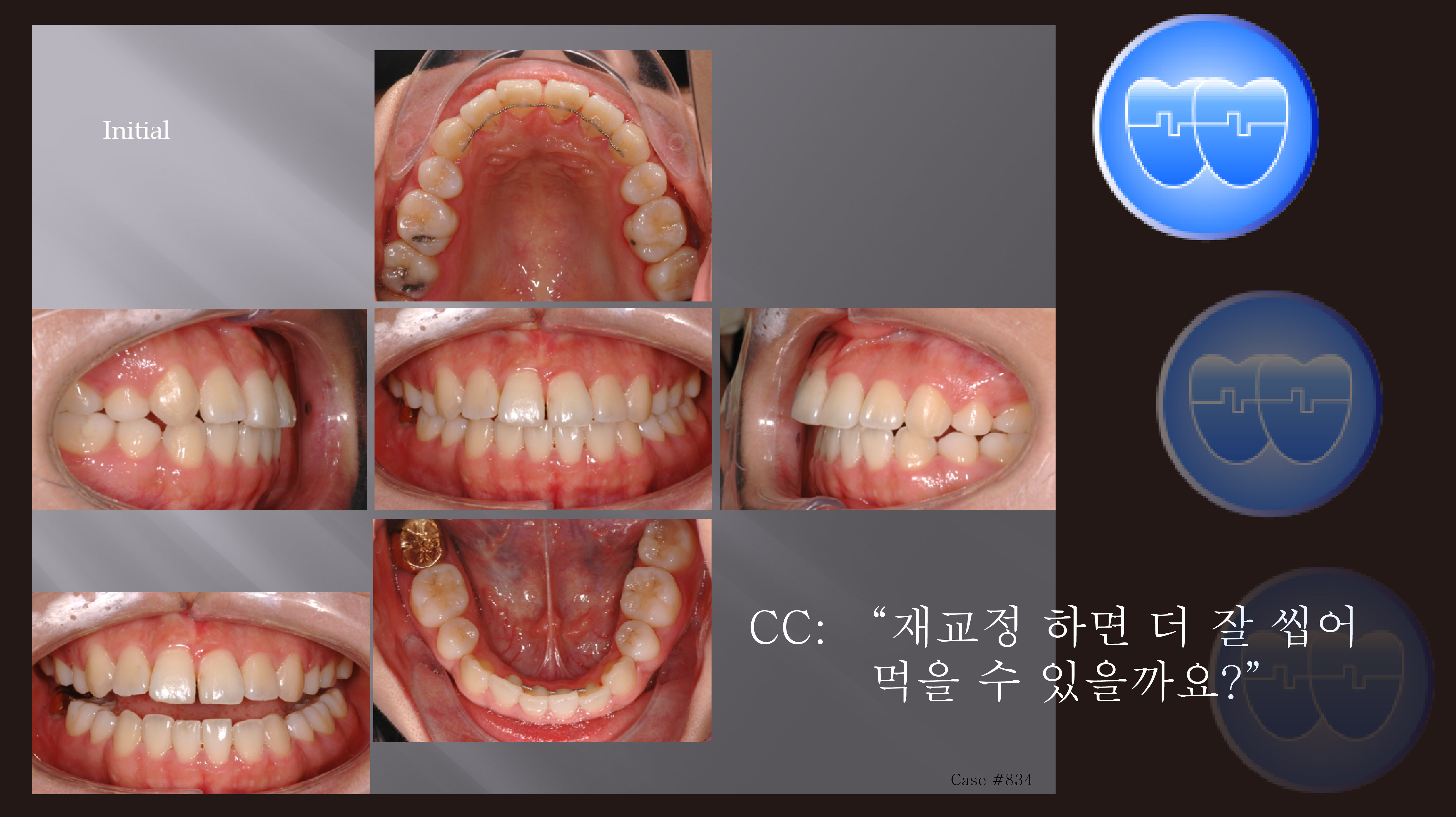 교정 Case 834. 재교정, Tilted Occlusal Table, Arch Coordination, Sem #19