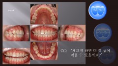 교정 Case 834. 재교정, Tilted Occlusal Table, Arch Coordination, Sem #19