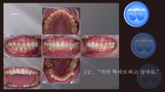 교정 Case 1321. 비발치, Severe Lower Crowding, Sem #11