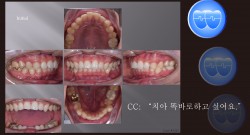 교정 Case 1321. 비발치, Severe Lower Crowding, Sem #11