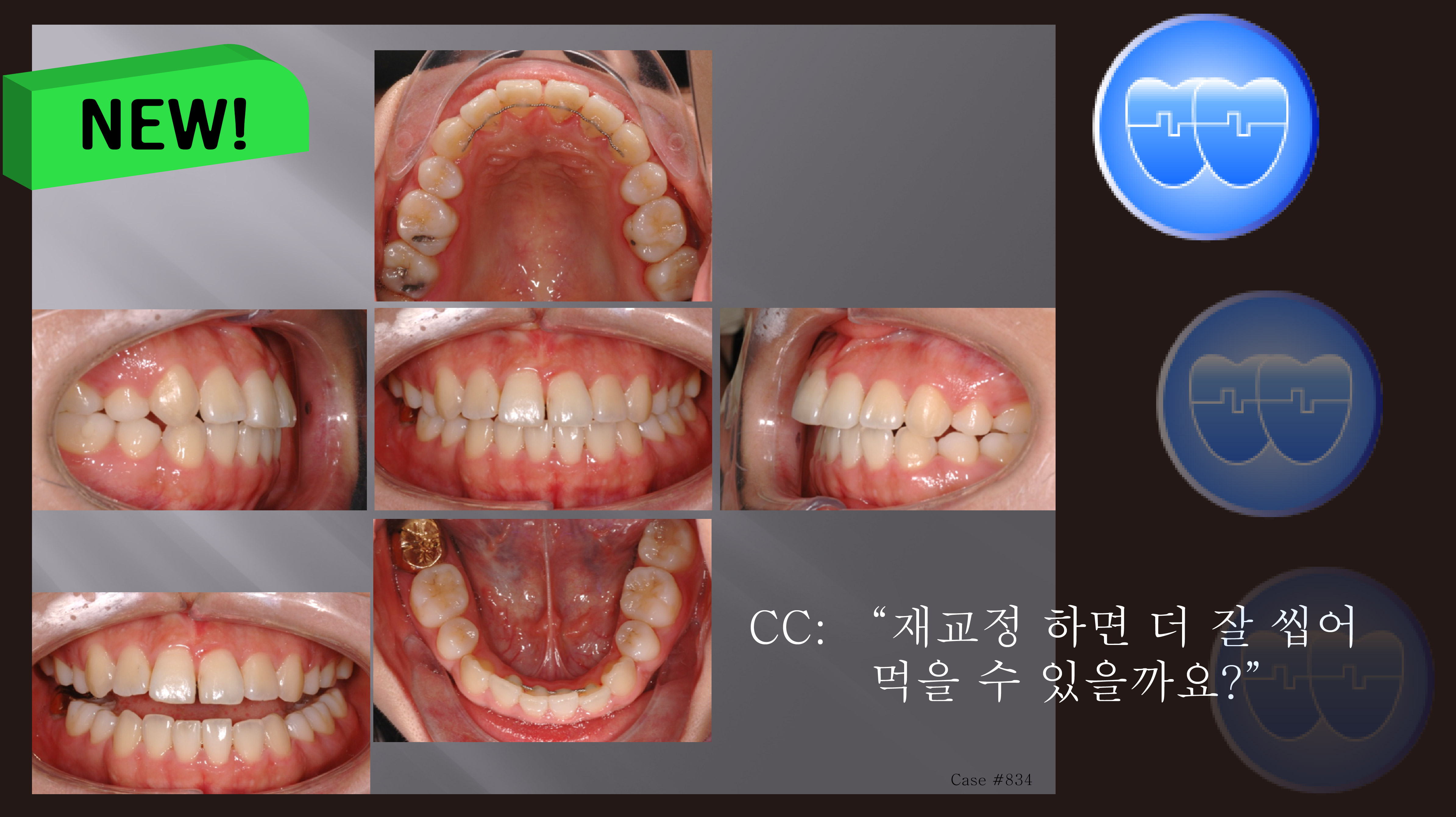 교정 Case 834. 재교정, Tilted Occlusal Table, Arch Coordination, Sem #19